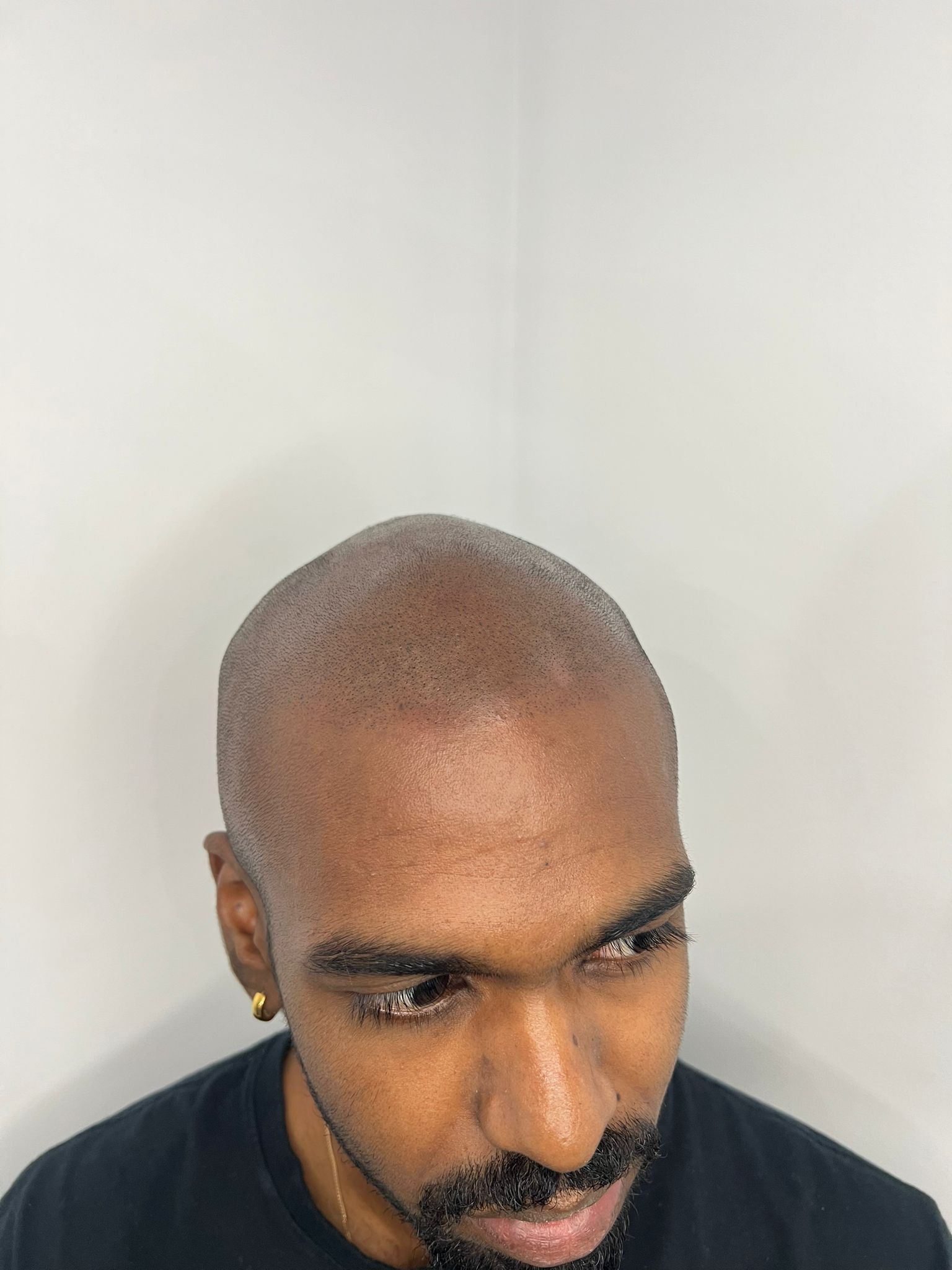 Alopecia SMP